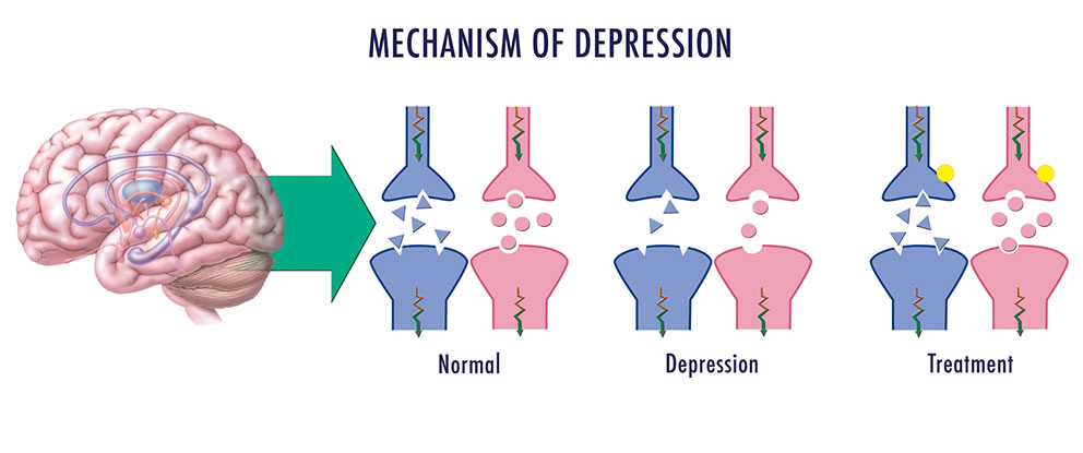 Image result for depression neurotransmitter