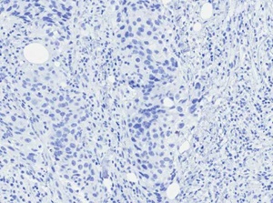 Patient Tumor for PDX Model TM00089, PR Marker (Negative)