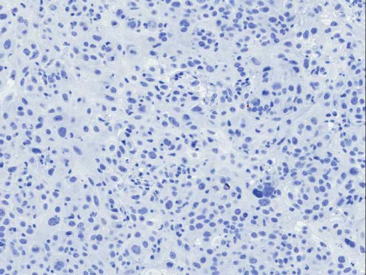 P1 Tumor for PDX Model TM00089, Estradiol Supplemented, PR Marker (Negative)