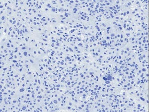 P1 Tumor for PDX Model TM00089, Estradiol Supplemented, PR Marker (Negative)