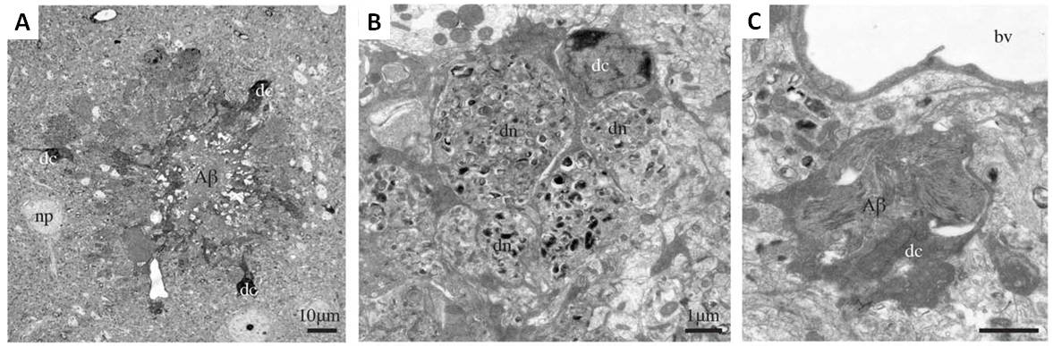 amyloid-beta plaque dark microglial cells