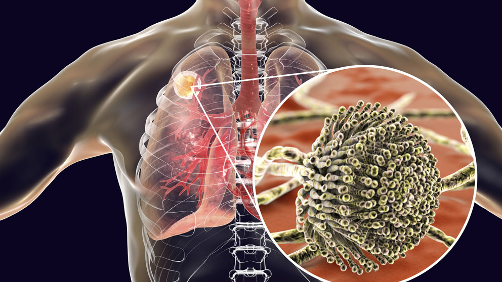  New $3M NIH Grant Targets Respiratory Infection with Mathematical Modeling 