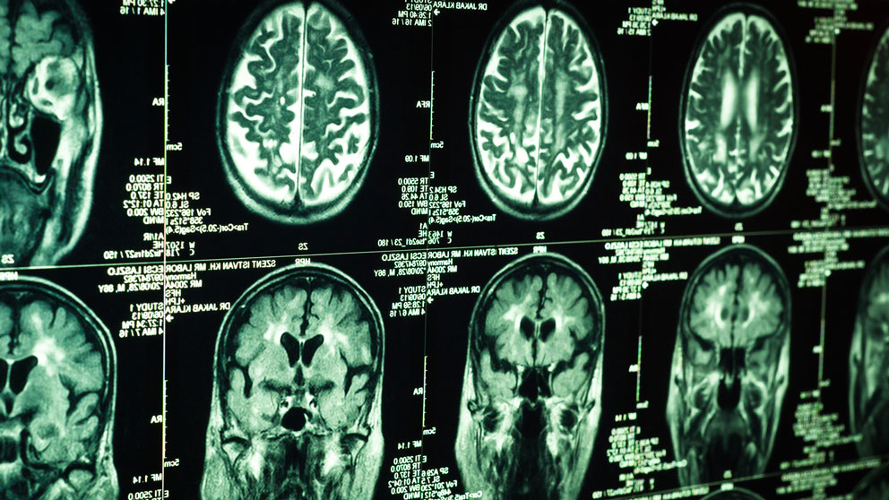 scan of human brain