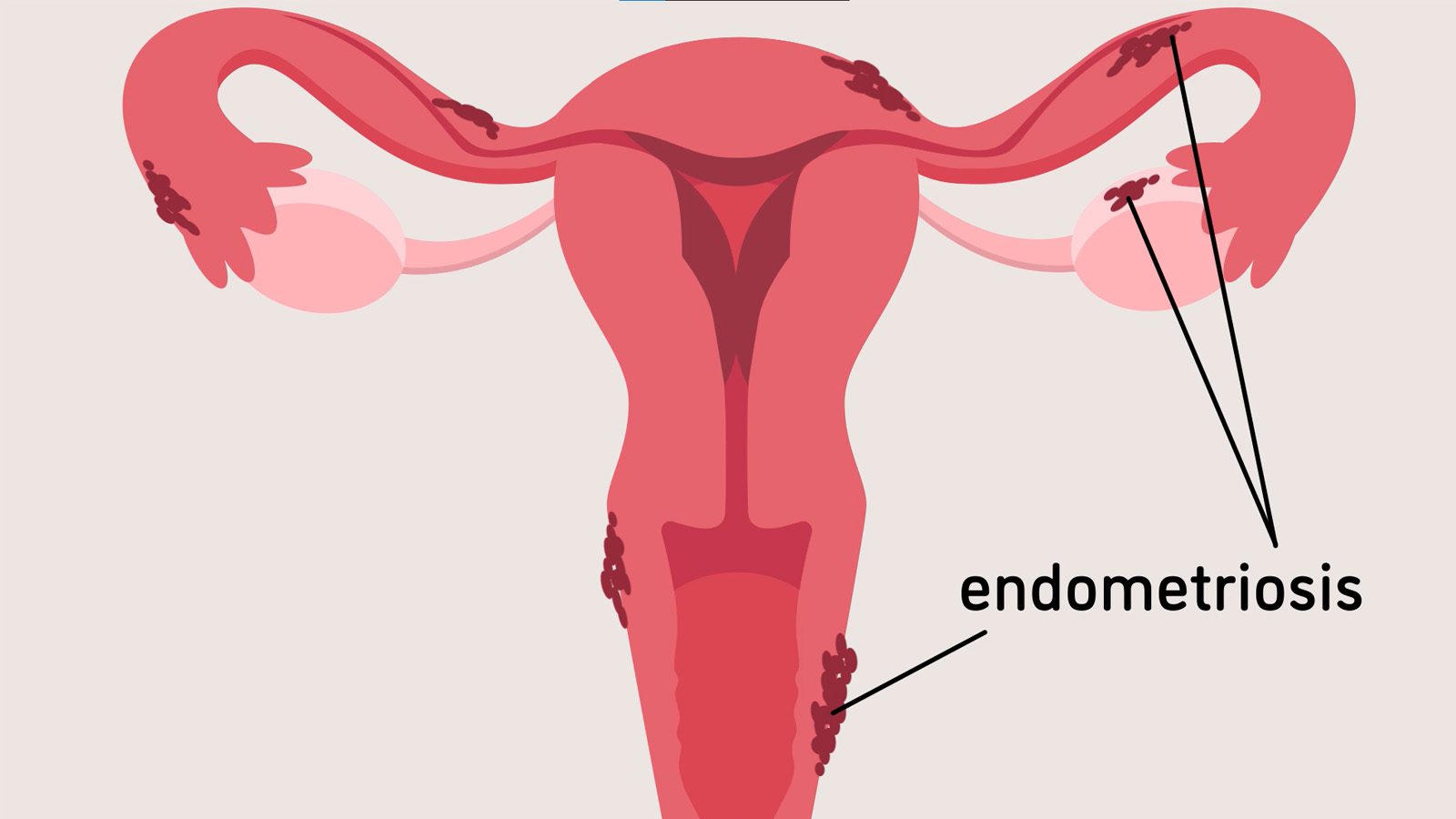 Jackson实验室“子宫内膜异位症是什么？”一分钟后了解的子宫图像。