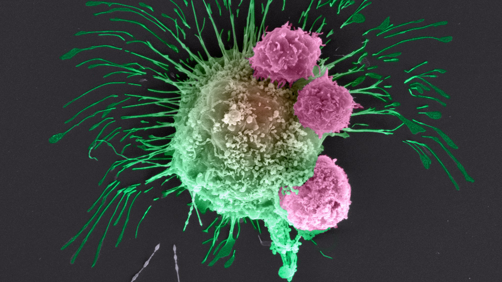 electron microscopy image of breast cancer cell 